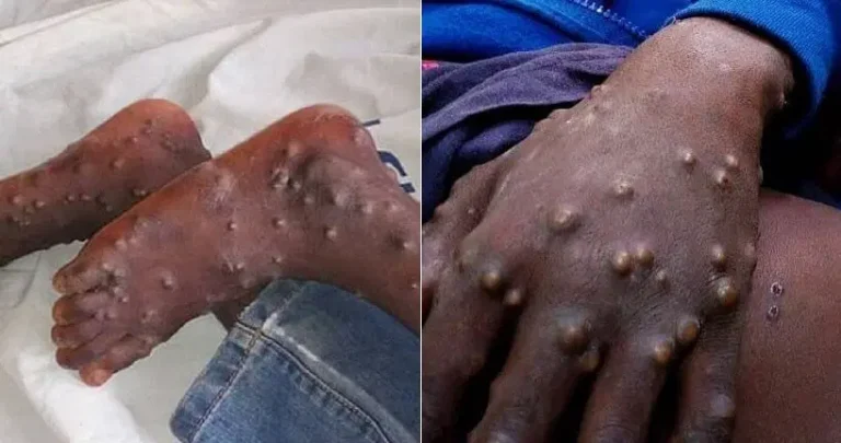 NCDC confirms 66 suspected cases of monkeypox, one death